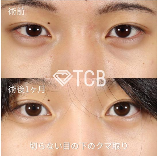 TCB東京中央美容外科の切らない目の下のクマ取り・目の下のたるみ（ふくらみ）とりの症例