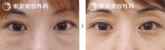 東京美容外科のハムラ法の症例