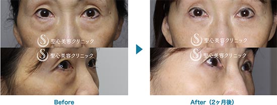 聖心美容クリニックのプレミアムPRP皮膚再生療法、目の下の脂肪取り（経結膜下脱脂法）の症例