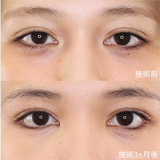 TAクリニックの下眼瞼脱脂術（目の下のたるみ取り・目の下の脂肪ふくらみ取り）の症例