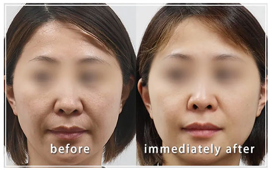 共立美容外科のケミカルピーリング(サリチル酸マクロゴール)の症例