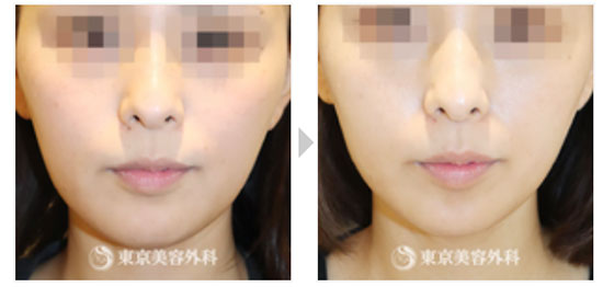 東京美容外科のルメッカ（インモード）の症例