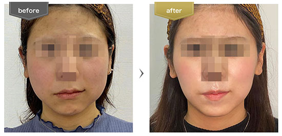 東京美容外科のエラボトックス注射による小顔・輪郭整形（ボツリヌストキシン）
の症例