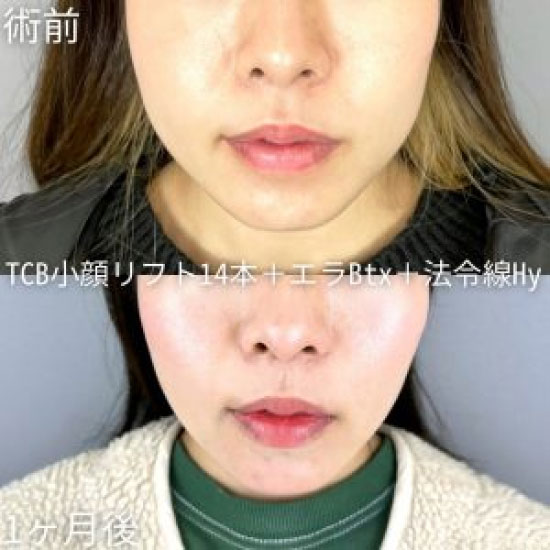 TCB東京中央美容外科のTCB小顔リフト14本＋エラボトックス＋ほうれい線ヒアルロン酸注射の症例