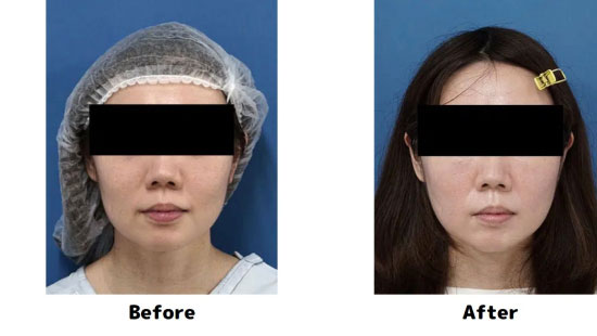 もとび美容外科クリニックのミントリフトミニフレックス（10本）＋脂肪溶解注射（チンセラプラス）の症例