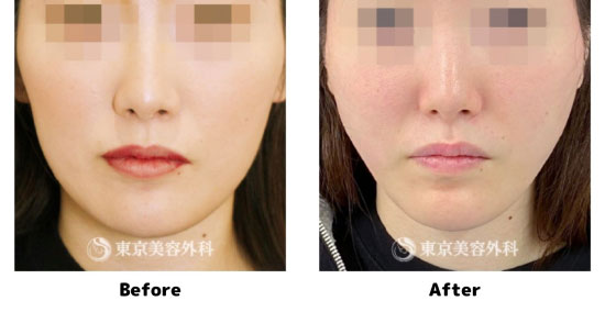 東京美容外科の糸リフト（オルチャンリフト）の症例
