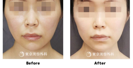 東京美容外科のミントリフトⅡ Wink（6本ずつ）の症例