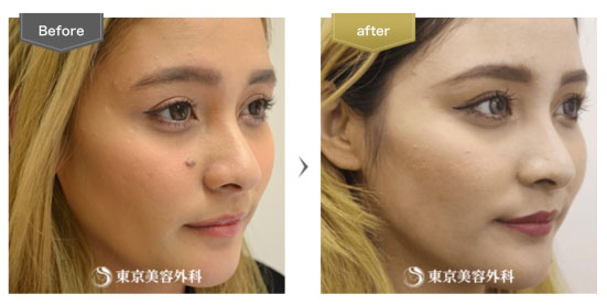 東京美容外科の施術名：ほくろ除去（切開）の症例