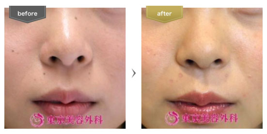 東京美容外科の施術名：ほくろ除去の症例
