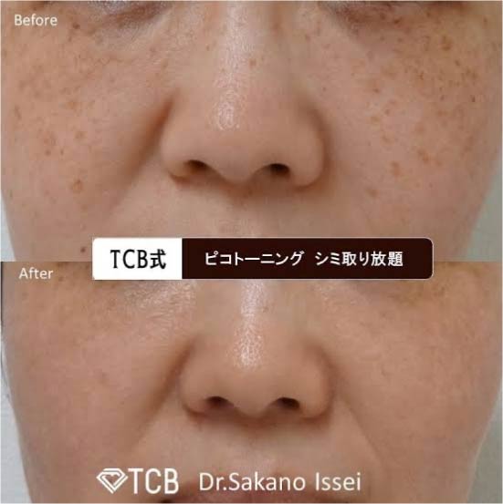 TCB東京中央美容外科のシミ取り放題の症例