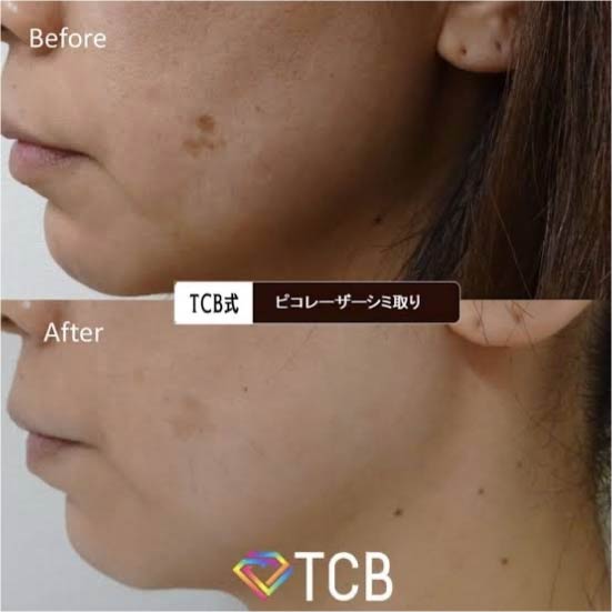 TCB東京中央美容外科のシミ取りの症例