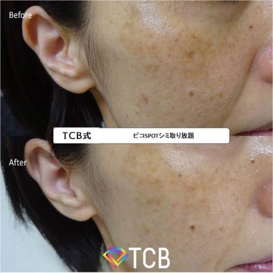 TCB東京中央美容外科のシミ取り放題の症例