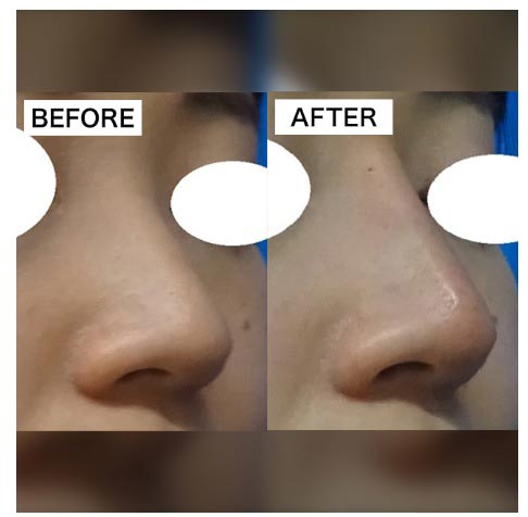 TCB東京中央美容外科のヒアルロン酸注射　鼻の症例