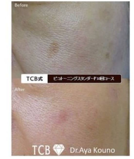 TCB東京中央美容外科のピコトーニングの症例