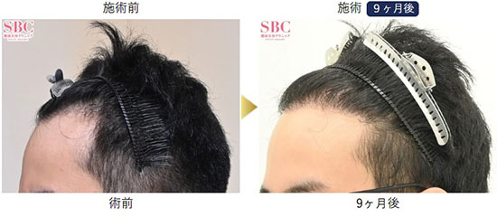 湘南美容クリニックの自毛植毛の症例