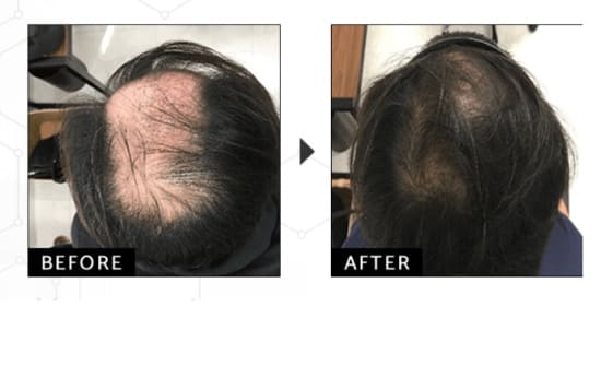 ウィルAGAクリニックの発毛トータルDXコースの症例