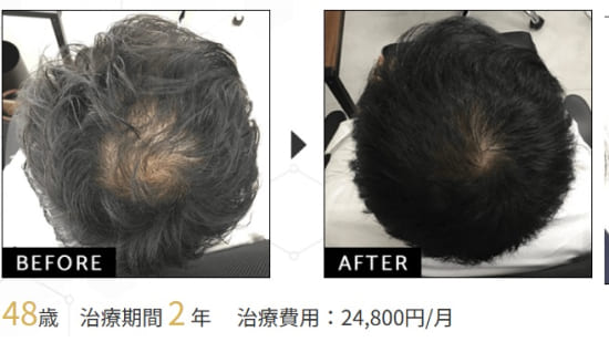 ウィルAGAクリニックの発毛トータルプレミアムコースの症例
