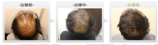 銀座総合美容クリニックの内服薬療法+ノーニードル育毛メソセラピの症例