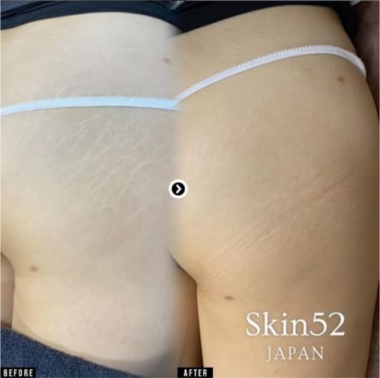 湘南美容クリニックのSkin52傷跡アートメイクの症例