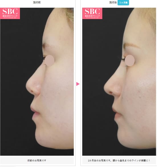 湘南美容クリニックのSBCナチュラルフィットプロテーゼ＋鼻尖形成術3D法＋鼻尖部軟骨移植の症例