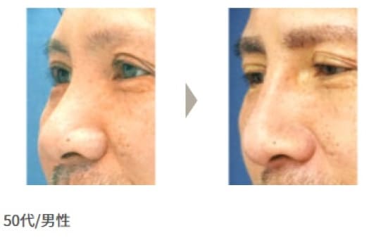 ガーデンクリニックの鼻のプロテーゼの症例