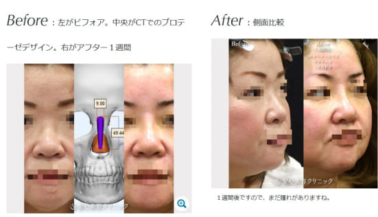 聖心美容クリニックの３Dオーダープロテーゼ＋耳介軟骨の症例