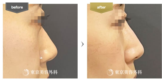 東京美容外科の隆鼻術（プロテーゼ）の症例