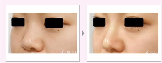東京美容外科の鼻中隔延長術の症例