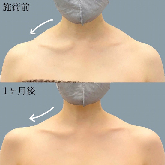 TCB東京中央美容外科の肩ボトックスの症例