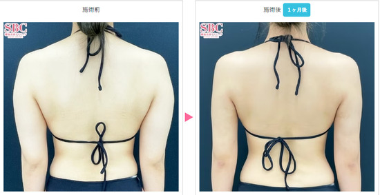 湘南美容クリニックの二の腕脂肪吸引＋肩ボトックスの症例
