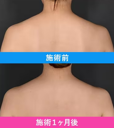 湘南美容クリニックの肩ボトックス・肩こりボトックスの症例