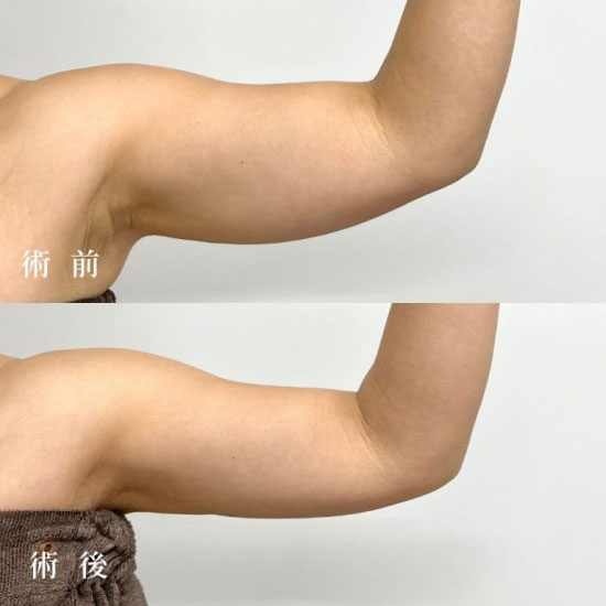 TCB東京中央美容外科の二の腕・肩 脂肪吸引の症例