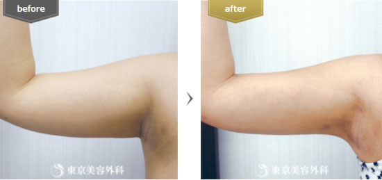 東京美容外科の脂肪吸引（二の腕）の症例
