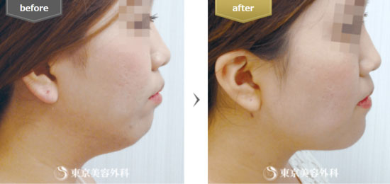 東京美容外科の脂肪吸引（フェイスライン）の症例