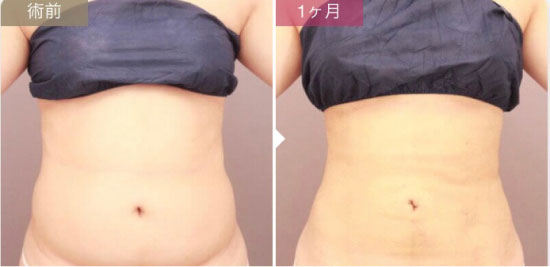 モッズクリニックのベイザー脂肪吸引（お腹全体＋胸下＋腰）の症例