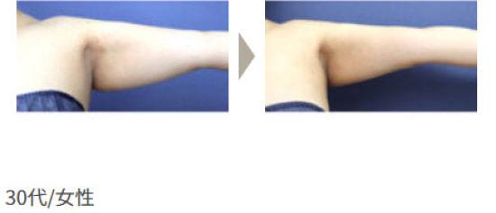 ガーデンクリニックの脂肪吸引（二の腕・腕の付け根）の症例