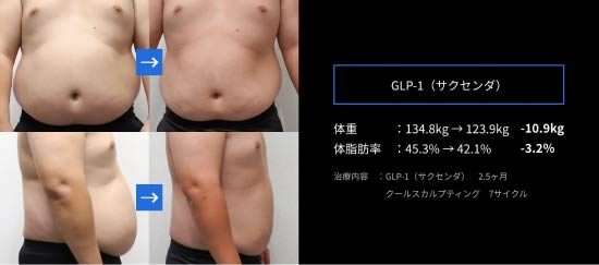 ゴリラクリニックの GLP-1（サクセンダ）の症例