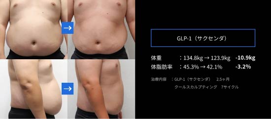 GLP-1（サクセンダ）によるダイエット症例