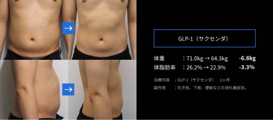 GLP-1（サクセンダ）によるダイエット症例