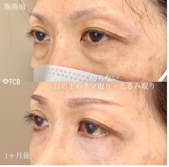 TCB東京中央美容外科の切開法による目の下のたるみ取り（下眼瞼除去術）の症例