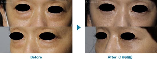 聖心美容クリニックのプレミアムPRP皮膚再生療法（目の下のくま）、目の下の脂肪取り（経結膜下脱脂法）の症例