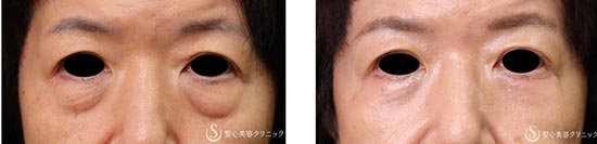 聖心美容クリニックの下眼瞼除皺術(脂肪除去あり)の症例