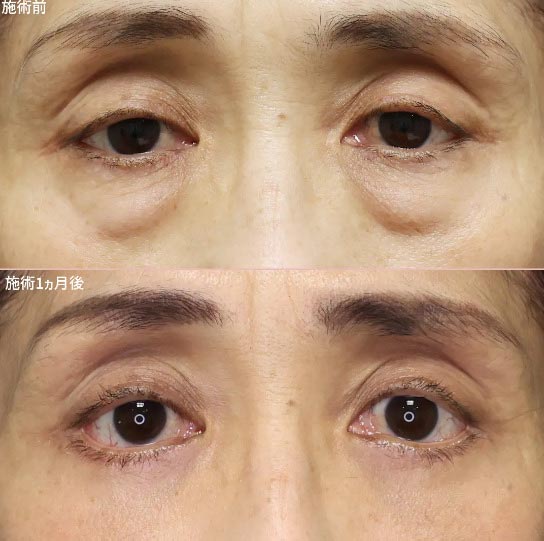 TAクリニックの下眼瞼脱脂術(目の下のふくらみ・クマ取り)								の症例