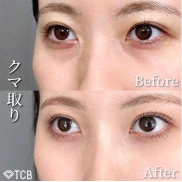 TCB東京中央美容外科の切らない目の下のクマ取り・目の下のたるみ（ふくらみ）取り								の症例