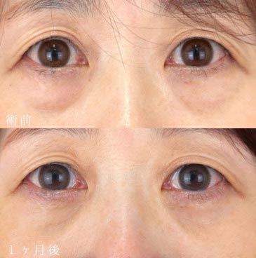 TCB東京中央美容外科の切らない目の下のクマ取り・目の下のたるみ（ふくらみ）取り                                               の症例