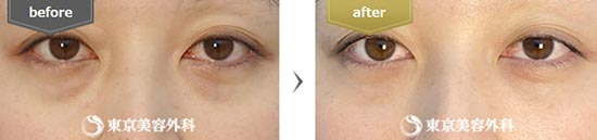 東京美容外科の切らない目の下のクマ・たるみ取り（経結膜アプローチ法）								の症例