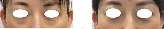 東郷美容形成外科の目の下の脂肪除去（経結膜脱脂）の症例