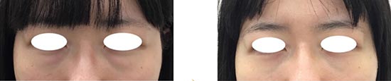 東郷美容形成外科の目の下の脂肪除去（経結膜脱脂）の症例