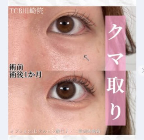 TCB東京中央美容外科の切らない目の下のクマ取り・たるみ取りの症例