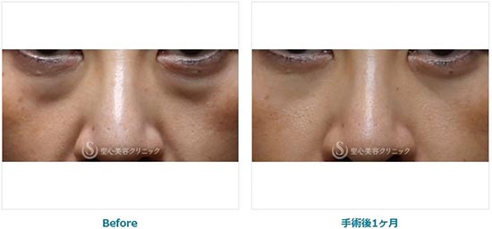 聖心美容クリニックの目の下の脂肪取り（経結膜下脱脂法）の症例